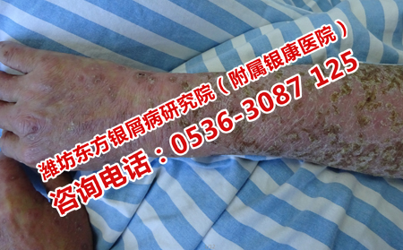 得了牛皮癣应该怎样治疗