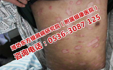 济南哪家医院治疗牛皮癣较靠谱