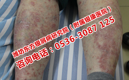 牛皮癣去哪儿治疗比较可以