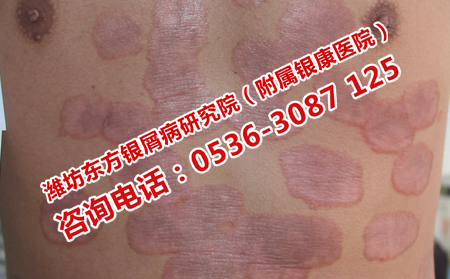 牛皮癣患者吃点什么比较可以