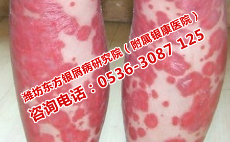 牛皮癣在日常应该怎样护理