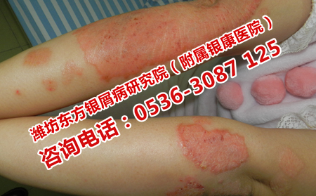 女性牛皮癣患者吃点什么比较可以
