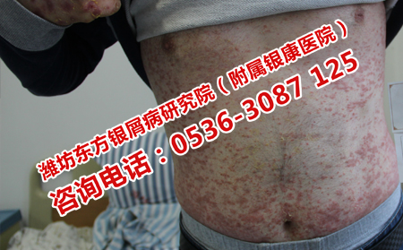 儿童牛皮癣患者治疗时应该注意什么问题