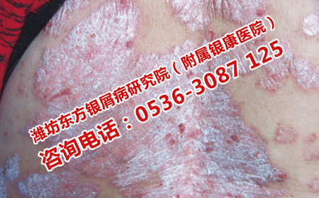 牛皮癣患者在日常生活中应该注意什么问题