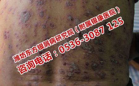 得了脓疱型牛皮癣应该怎样治疗