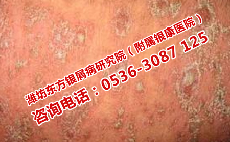 怎样治疗关节型牛皮癣