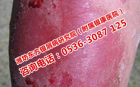 如何争正确治疗牛皮癣