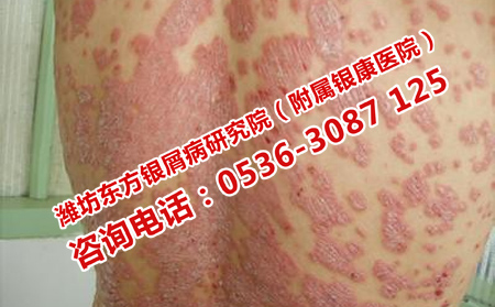 牛皮癣的危害有多大