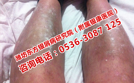 牛皮癣如何治疗效果可以