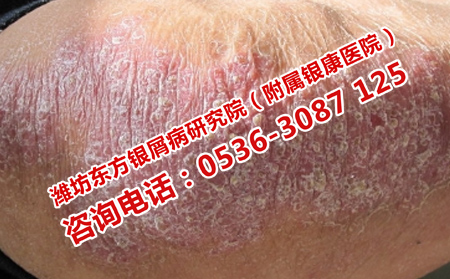 怎么护理牛皮癣恢复效果理想