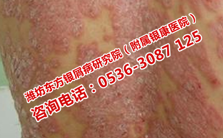 牛皮癣都有哪些危害