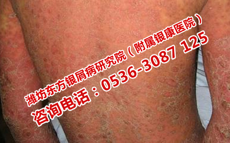银屑病要到大医院治疗吗