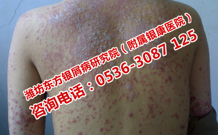 牛皮癣常规治疗方法的弊端
