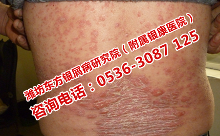 牛皮癣有效的护理方法是什么