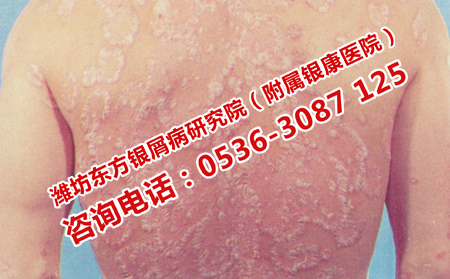 治疗牛皮癣的主要方法