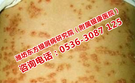 牛皮癣发病的根源是什么
