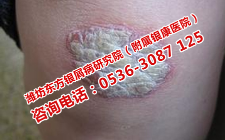 顽固银屑病的治疗