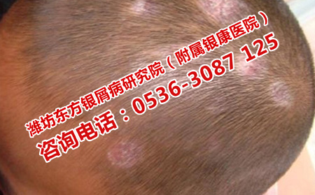 扩散的牛皮癣要如何护理