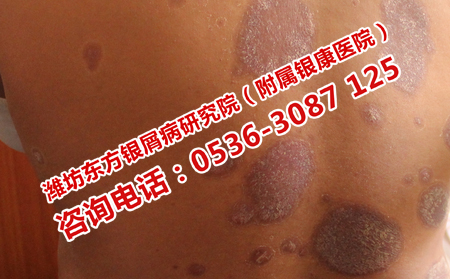 牛皮癣在老年复发的原因