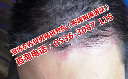 银屑病从头部开始是为什么