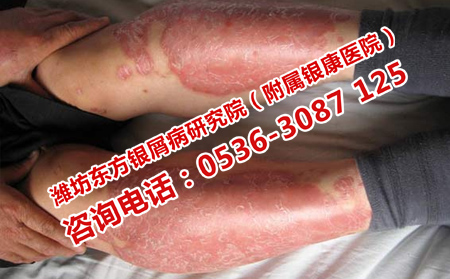 快速治可以牛皮癣的方法
