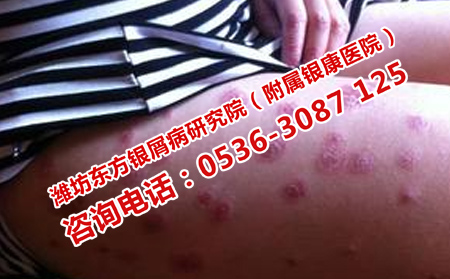 银屑病冬季复发的原因