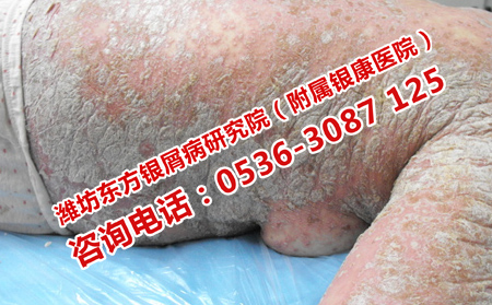 治疗银屑病抗复发的医院