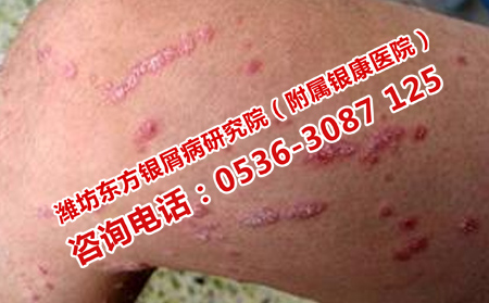 全身点滴型银屑病的治疗