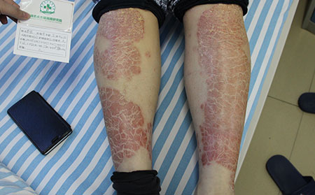 银屑病患者夏季如何洗澡