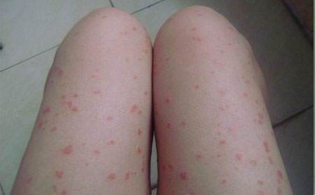 影响银屑病运动的因素