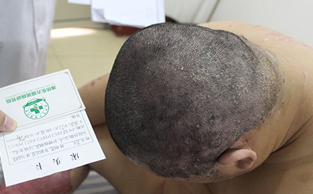 头部银屑病夏季护理