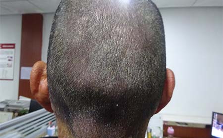 银屑病瘙痒原因